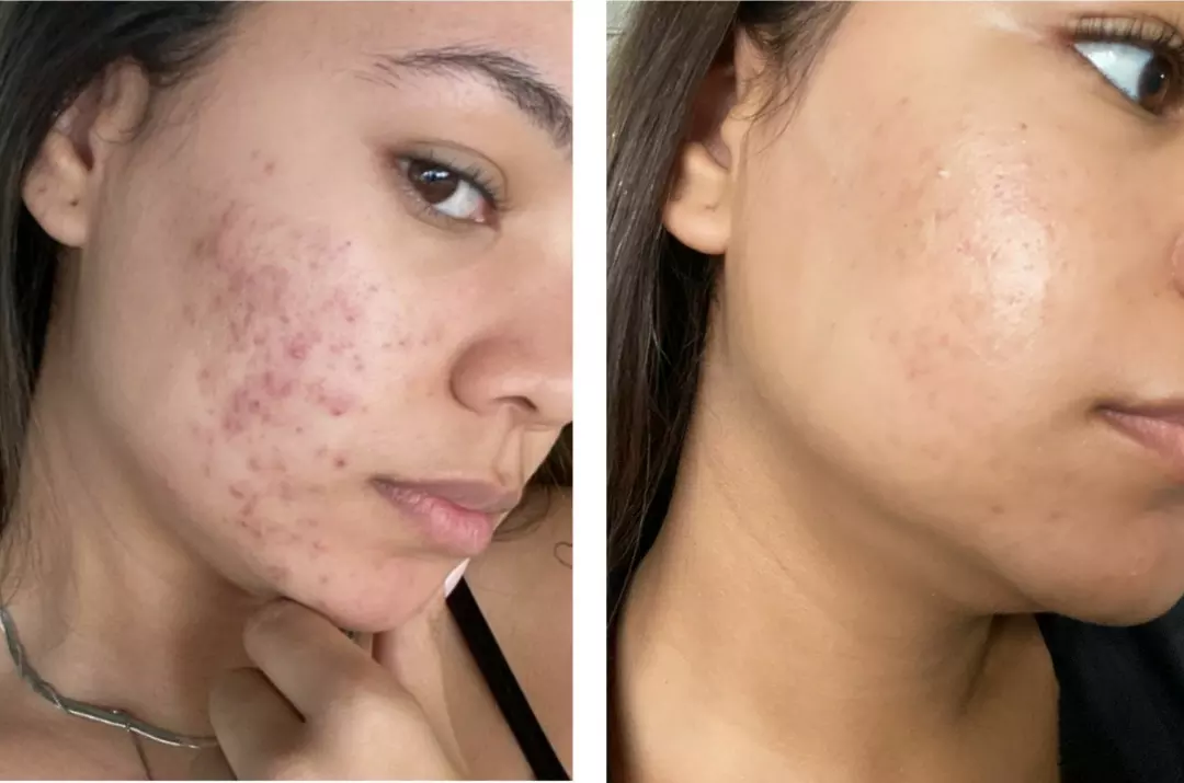 Antes e depois de tratamento facial