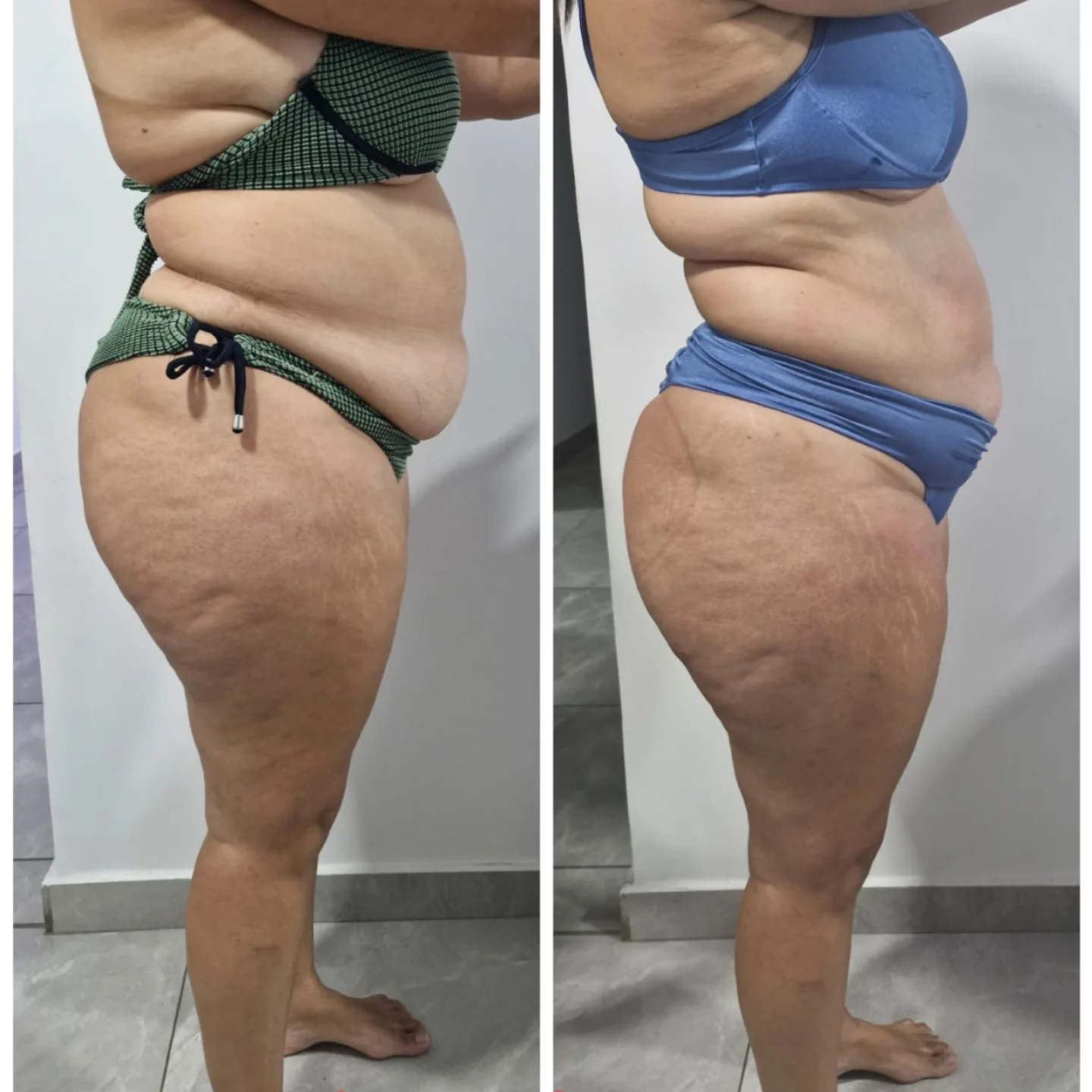 Antes e depois lateral de tratamento corporal